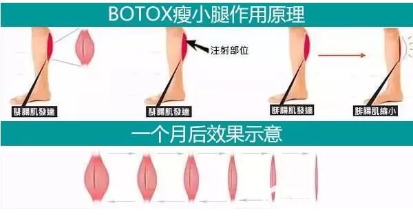 瘦脸除皱瘦腿作用原理及术后一月效果 瘦脸除皱瘦腿作用原理及术后一月效果