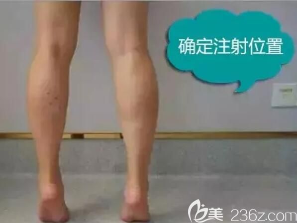 术前垫脚确定注射瘦脸除皱位置 术前垫脚确定注射瘦脸除皱位置
