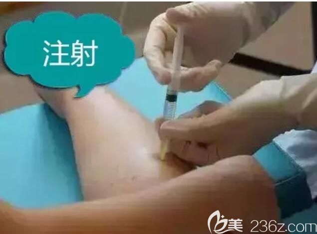 无锡爱思特医生注射瘦腿操作中 无锡爱思特医生注射瘦腿操作中
