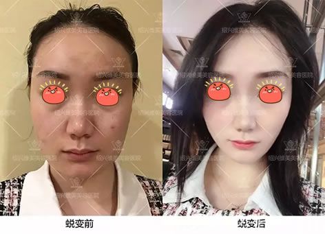 绍兴维美李俊霞面部线雕案例 绍兴维美李俊霞面部线雕案例