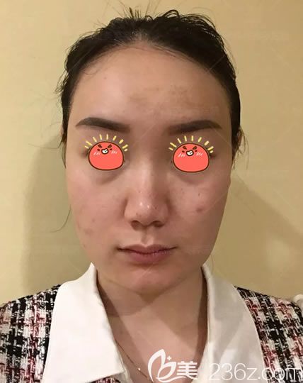 绍兴维美整形做面部线雕手术前 绍兴维美整形做面部线雕手术前