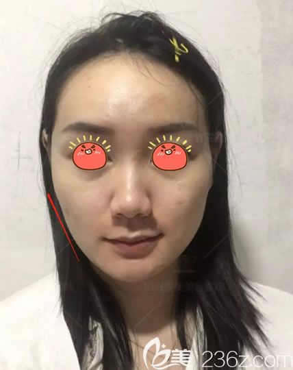 绍兴维美李俊霞面部线雕半张脸效果 绍兴维美李俊霞面部线雕半张脸效果