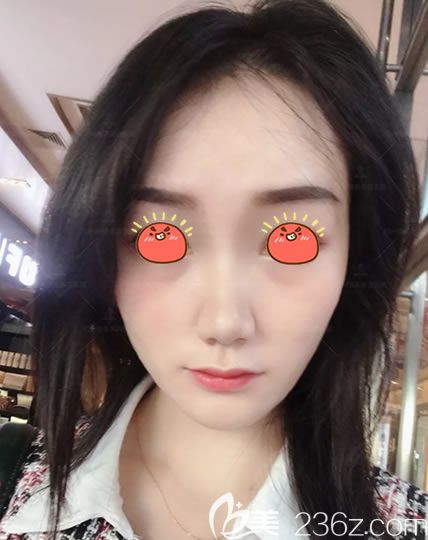 绍兴维美整形面部线雕案例 绍兴维美整形面部线雕案例