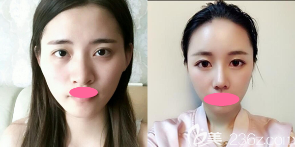 上饶尚美张维华鼻综合整形一个月效果图展示 上饶尚美张维华鼻综合整形一个月效果图展示