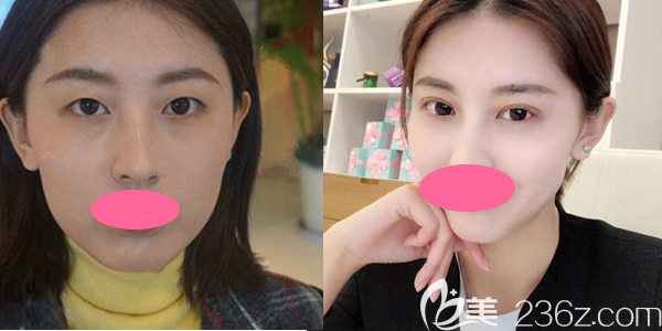 上饶尚美切开双眼皮一个月效果图 上饶尚美切开双眼皮一个月效果图