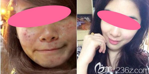 上饶尚美激光祛痘两个疗程效果图 上饶尚美激光祛痘两个疗程效果图