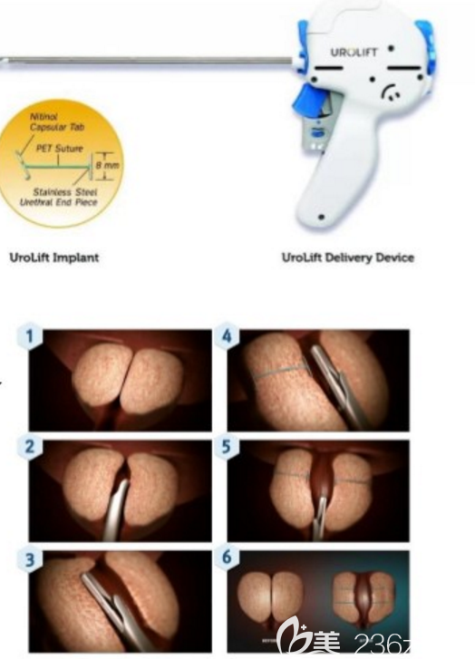 前列腺肥大Urolift微创手术 前列腺肥大Urolift微创手术