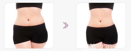 韩国光明整形外科吸脂手术案例 韩国光明整形外科吸脂手术案例