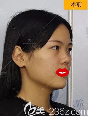 在石家庄蓝山做隆鼻前是朝天鼻 在石家庄蓝山做隆鼻前是朝天鼻