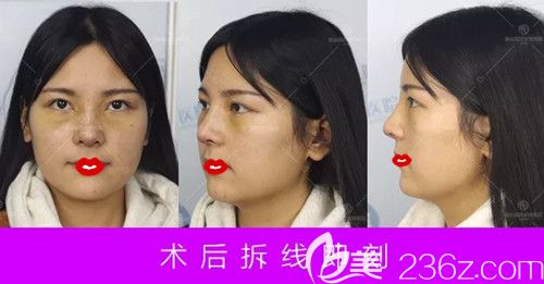 卢闯医生为我做肋软骨隆鼻术后7天进行拆线 卢闯医生为我做肋软骨隆鼻术后7天进行拆线