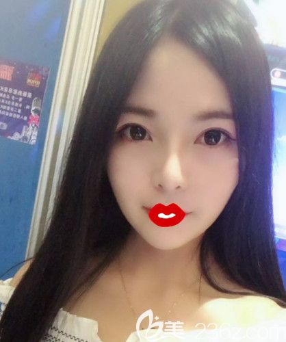 在石家庄蓝山做肋软骨隆鼻18天完全消肿 在石家庄蓝山做肋软骨隆鼻18天完全消肿