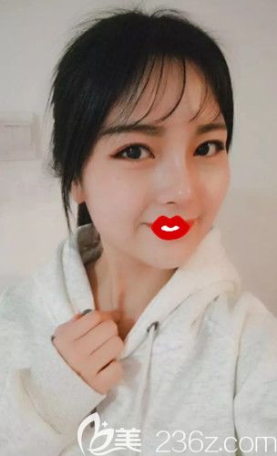 卢闯医生为我做肋软骨隆鼻25天鼻子变立体 卢闯医生为我做肋软骨隆鼻25天鼻子变立体