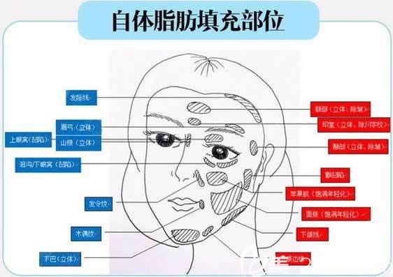 想知道自体脂肪丰太阳穴多少钱的,看这里嘉兴曙光公布了脂肪填充类手术价格啦