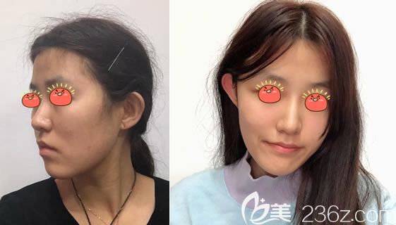 嘉兴曙光自体脂肪丰苹果肌<span style= 嘉兴曙光自体脂肪丰苹果肌<span style=