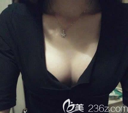 自卑的平胸妹在北海韩美整形做曼托水滴形毛面假体隆胸40天后,变的自信满满