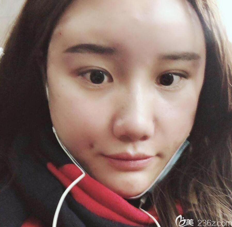 胡准刚做完自体脂肪填充全脸术后照