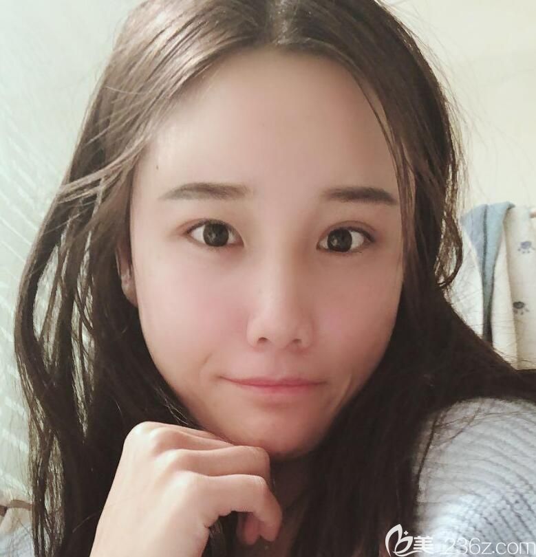 脂肪填充全脸术后第3天