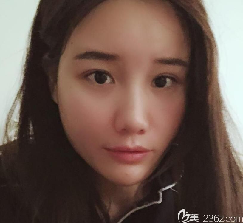 合肥白领安琪儿面部自体脂肪填充第7天效果