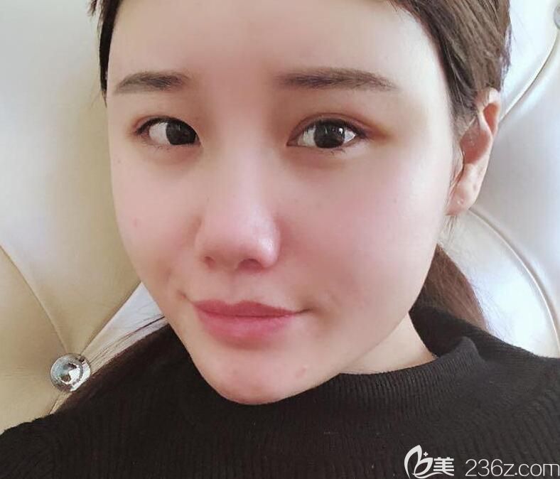 白领安琪儿全脸自体脂肪填充第10天