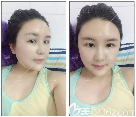 深圳美莱面部吸脂术后七天消肿效果 深圳美莱面部吸脂术后七天消肿效果