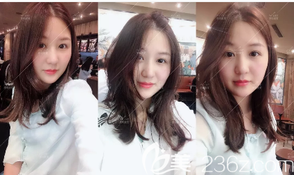 深圳美莱全身吸脂术后三个月反馈 深圳美莱全身吸脂术后三个月反馈