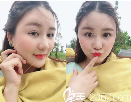 深圳美莱面部吸脂术后20天图片 深圳美莱面部吸脂术后20天图片