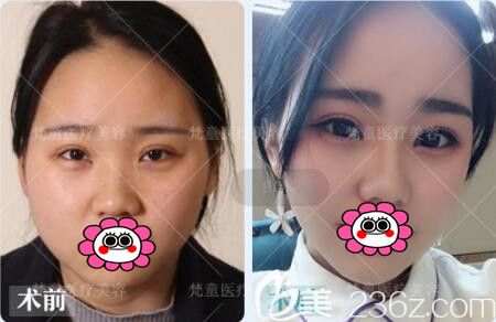 长沙梵童注射瘦脸瘦脸真人前后对比 长沙梵童注射瘦脸瘦脸真人前后对比