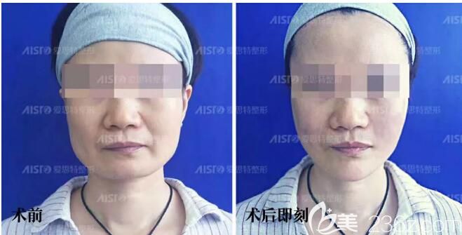 找高飞做线雕提升前后对比 找高飞做线雕提升前后对比