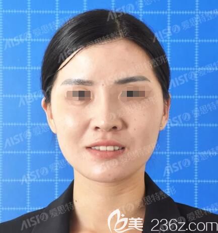 术前面诊无锡爱思特医生 术前面诊无锡爱思特医生