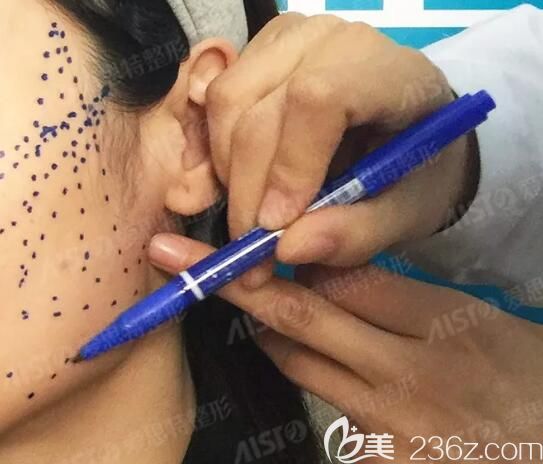 做线雕术前高飞医生划线设计 做线雕术前高飞医生划线设计