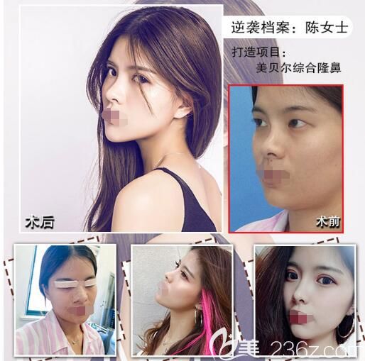 在南京美贝尔做眼鼻综合分享 在南京美贝尔做眼鼻综合分享