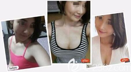 佳木斯韩艺来谷永安隆胸效果