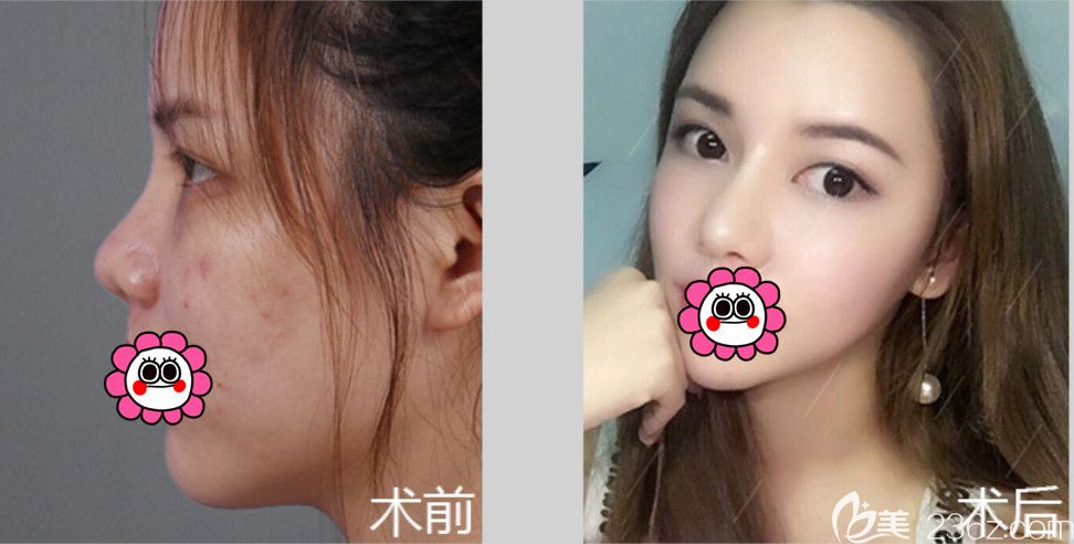 佳木斯韩艺来李明贤鼻综合整形效果