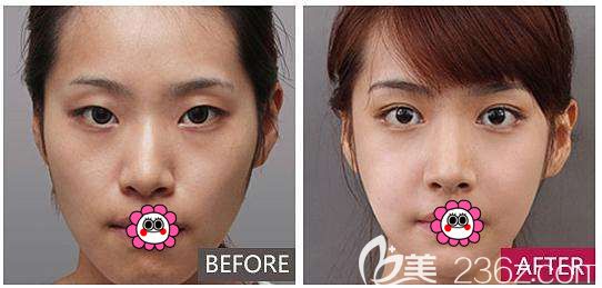佳木斯韩艺来张海港双眼皮案例效果
