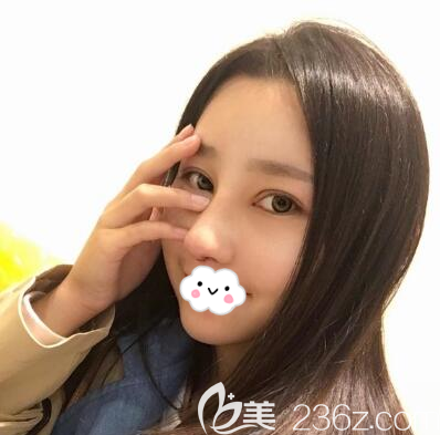 <i data-id='80057854-710c-4b8d-856f-9faaf1974202' style='display:none;'></i>文科隆鼻拆线后效果