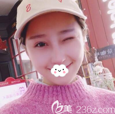 鼻综合手术后一个月的恢复图片