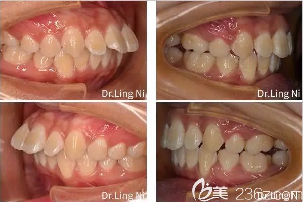 重庆维乐口腔医院文林医生成人龅牙矫正前后对比照
