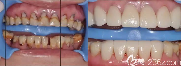 蔡菁菁医师树脂充填+全瓷冠修复案例效果对比图 蔡菁菁医师树脂充填+全瓷冠修复案例效果对比图