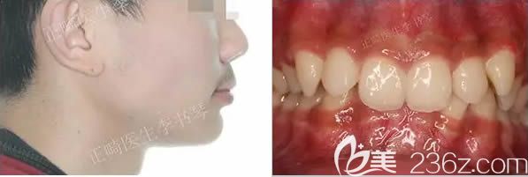 深覆颌矫正前的样子