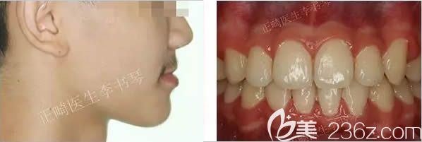 深覆颌矫正后的效果图