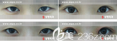 韩国s整形外科双眼皮手术案例