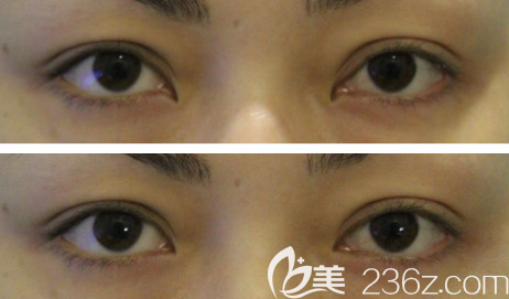 韩国右手整形开内眼角失败修复手术效果对比图