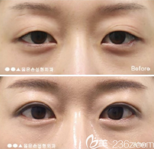 韩国右手整形外科双眼皮前后效果对比图