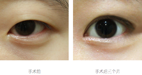韩国右手整形外科眼睑下垂矫正术前与术后3个月效果对比图