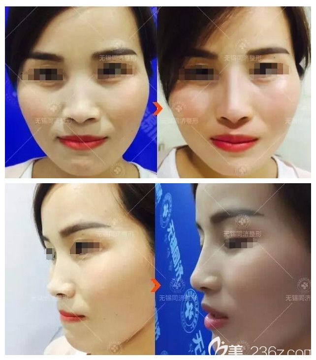 爱芙莱指定注射医生彭建分享玻尿酸注射隆鼻全过程 体验者看到术后效果对无锡同舟整形医院点赞