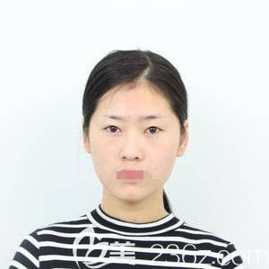 在郑州华领做自体脂肪填充和眼综合前 在郑州华领做自体脂肪填充和眼综合前