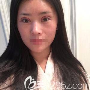 在郑州华领做自体脂肪填充和眼综合术后<span style= 在郑州华领做自体脂肪填充和眼综合术后<span style=