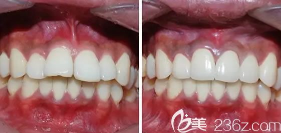 郑州拜博口腔隐形牙齿矫正案例