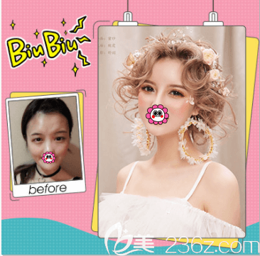 北京壹加壹张绿峰医生玖度魅眼案例 北京壹加壹张绿峰医生玖度魅眼案例