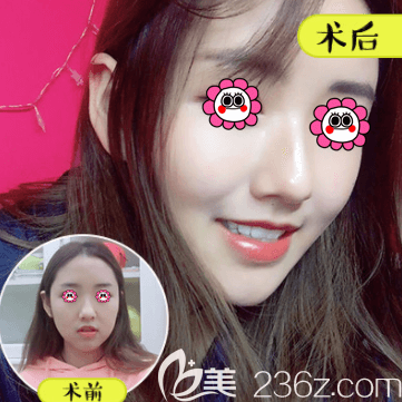 北京壹加壹田莹医生玻尿酸丰苹果肌案例 北京壹加壹田莹医生玻尿酸丰苹果肌案例